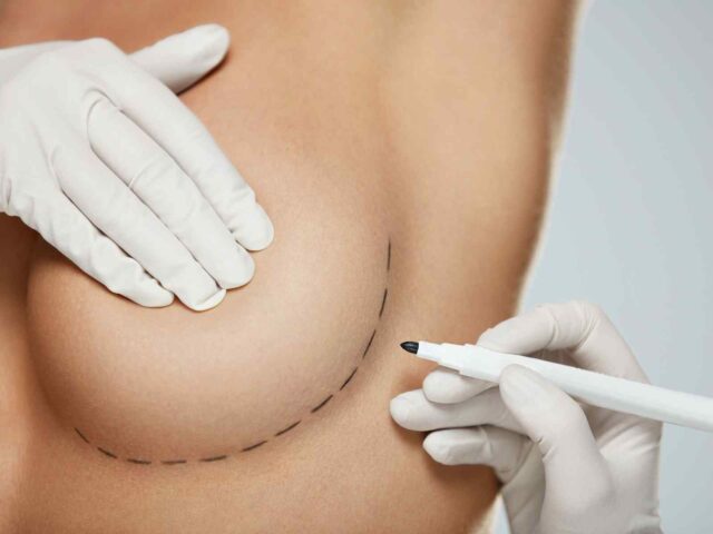 What to do After Breast Augmentation Surgery in Balat Aesthetic